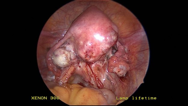 adenomyosis